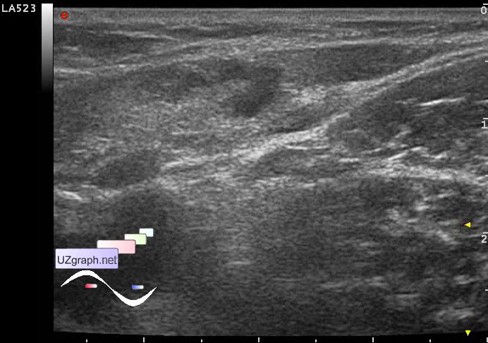 Soft Tissues Sonography Pain In Groin Clinical Report Video