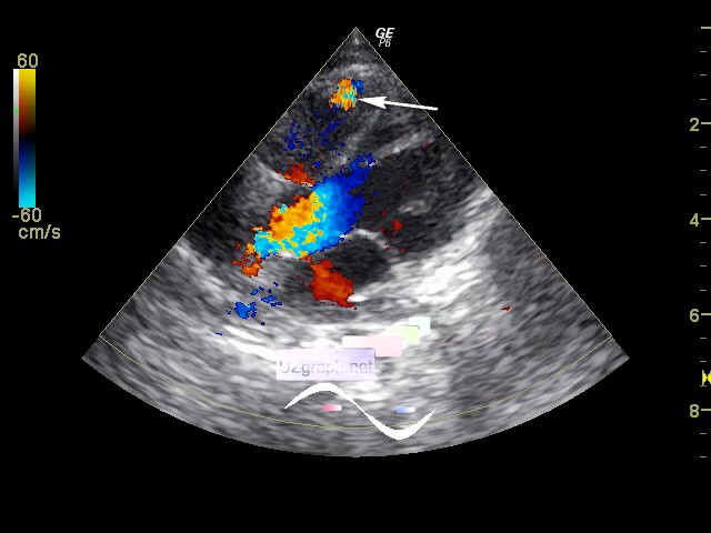 Cardiac sonography(Echocardiography) - Small IVSD - Clinical report ...