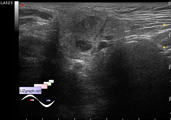 Soft tissues sonography - Focal parotitis - Clinical report, Video ...