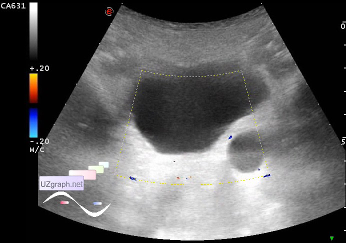 Urinary tract sonography - Ureterocele & megaureter - Clinical report ...