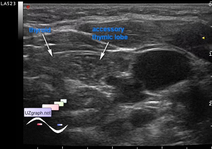 Thyroid gland sonography - Accessory thymic lobe - Clinical report ...