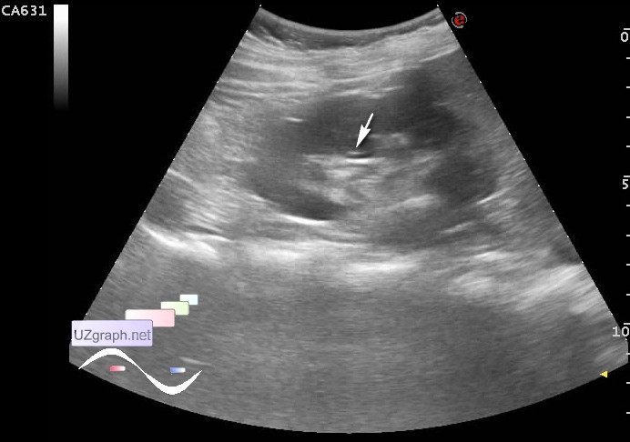 GB agenesis, Choledochal cysts, urolithiasis - Abdomen sonography ...