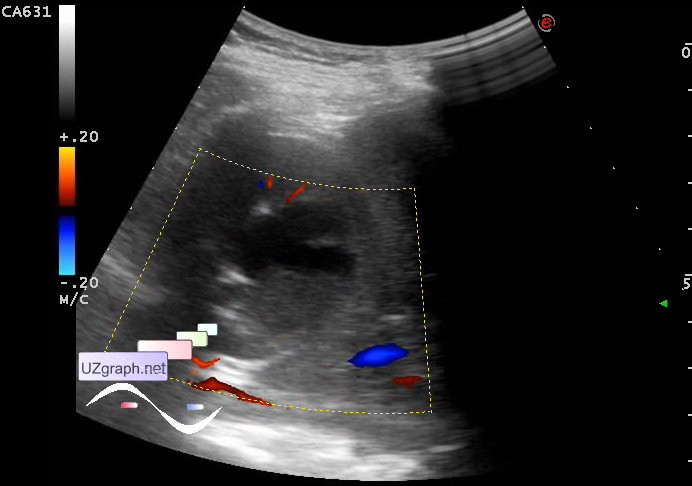 Urinary Tract Sonography Complicated Renal Cyst Clinical Report