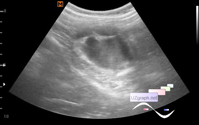 Lesion In The Right Upper Quadrant Abdomen Sonography Clinical Report Video Images