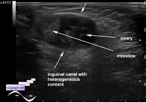 Abdomen sonography - Strangulated inguinal hernia - Clinical report ...